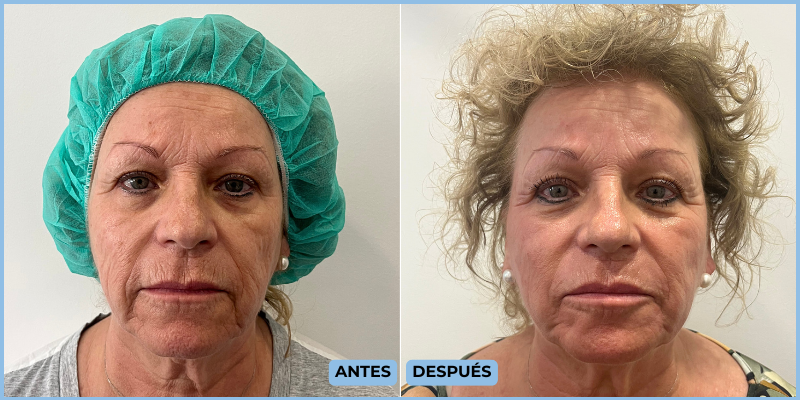 Resultado láser CO2 ONFACE Emilia