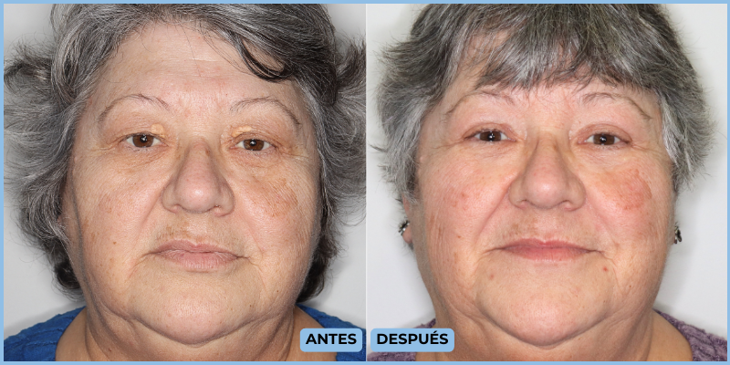 Resultado láser CO2 ONFACE María José Colomar